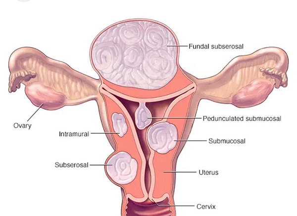 • A diagram on types of fibroids