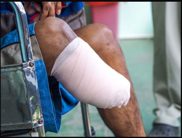 • A patient with an amputated leg